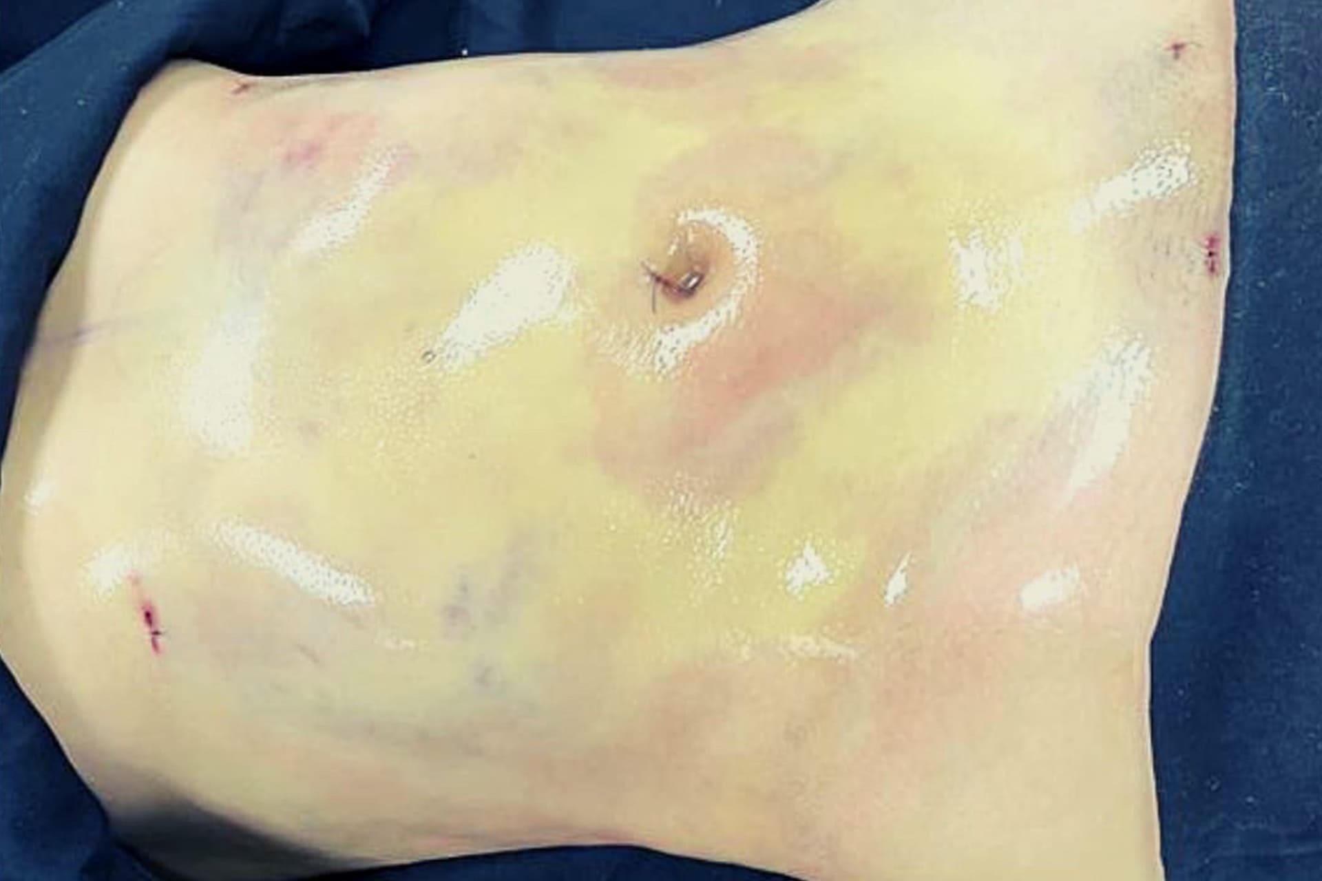 abdominoplastia