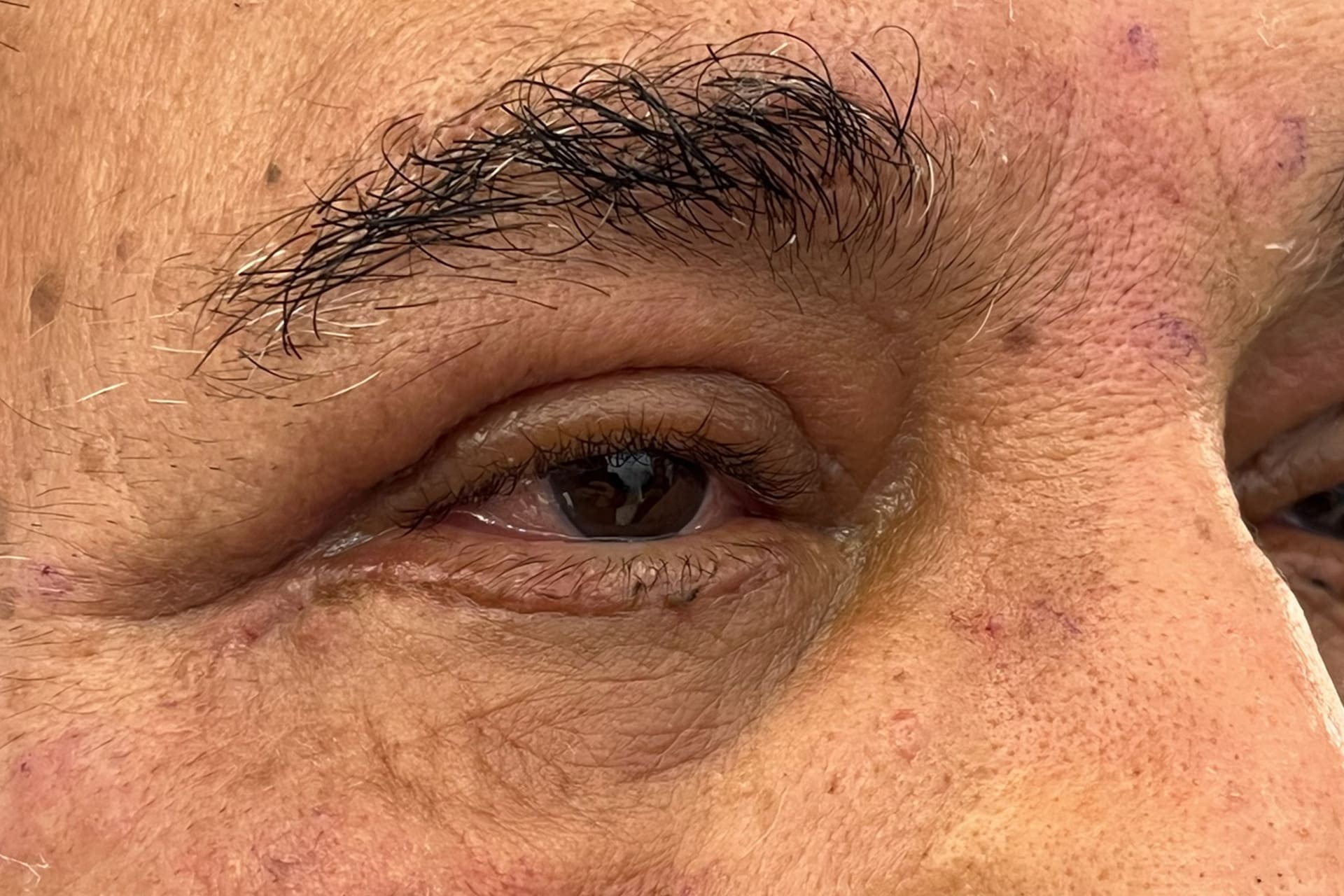 blefaroplastia