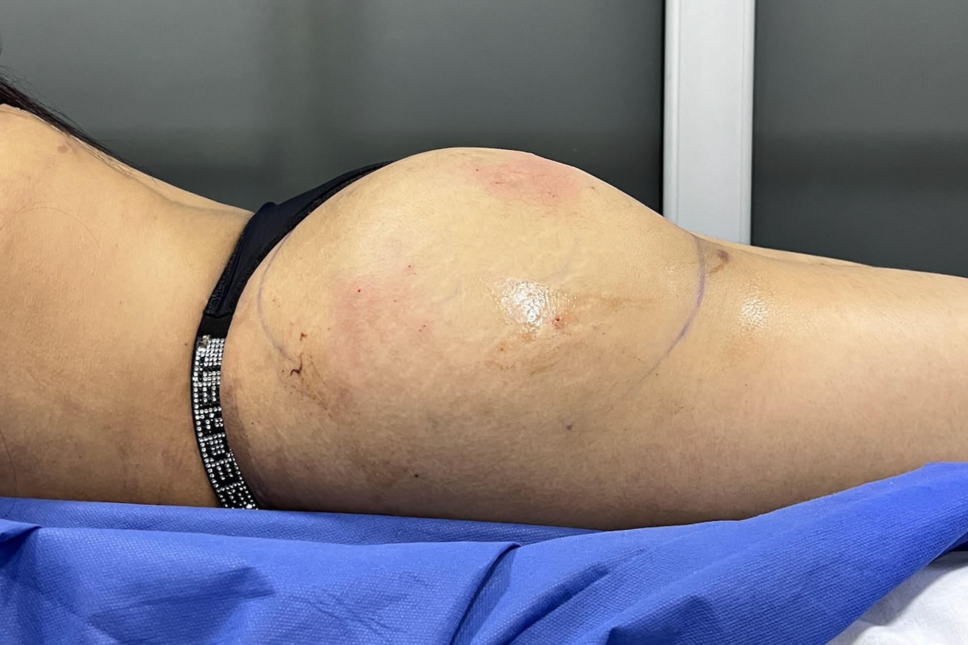 lipo-gluteo