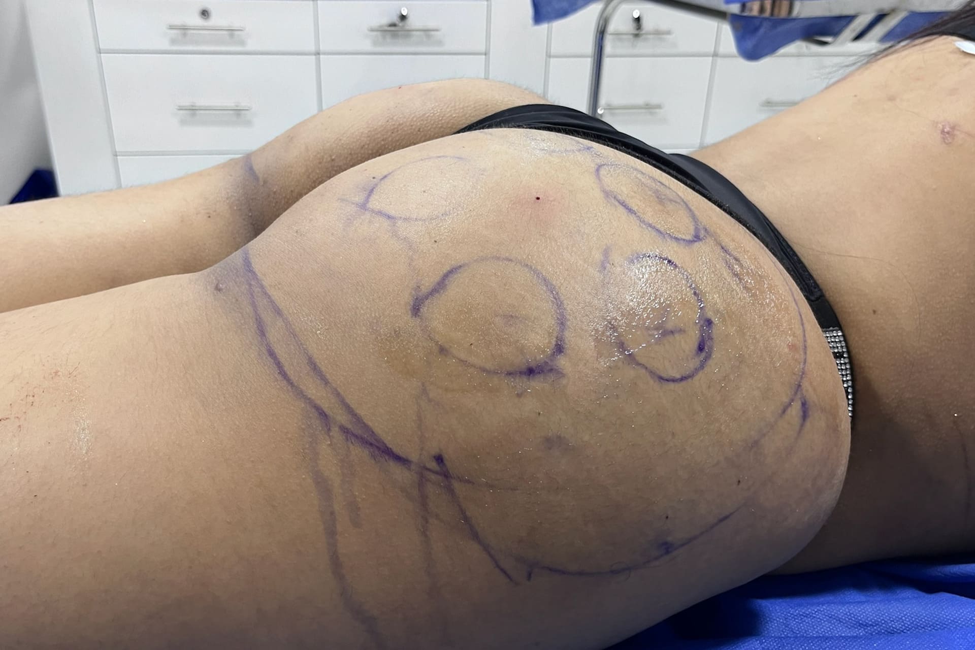 lipo-gluteo2
