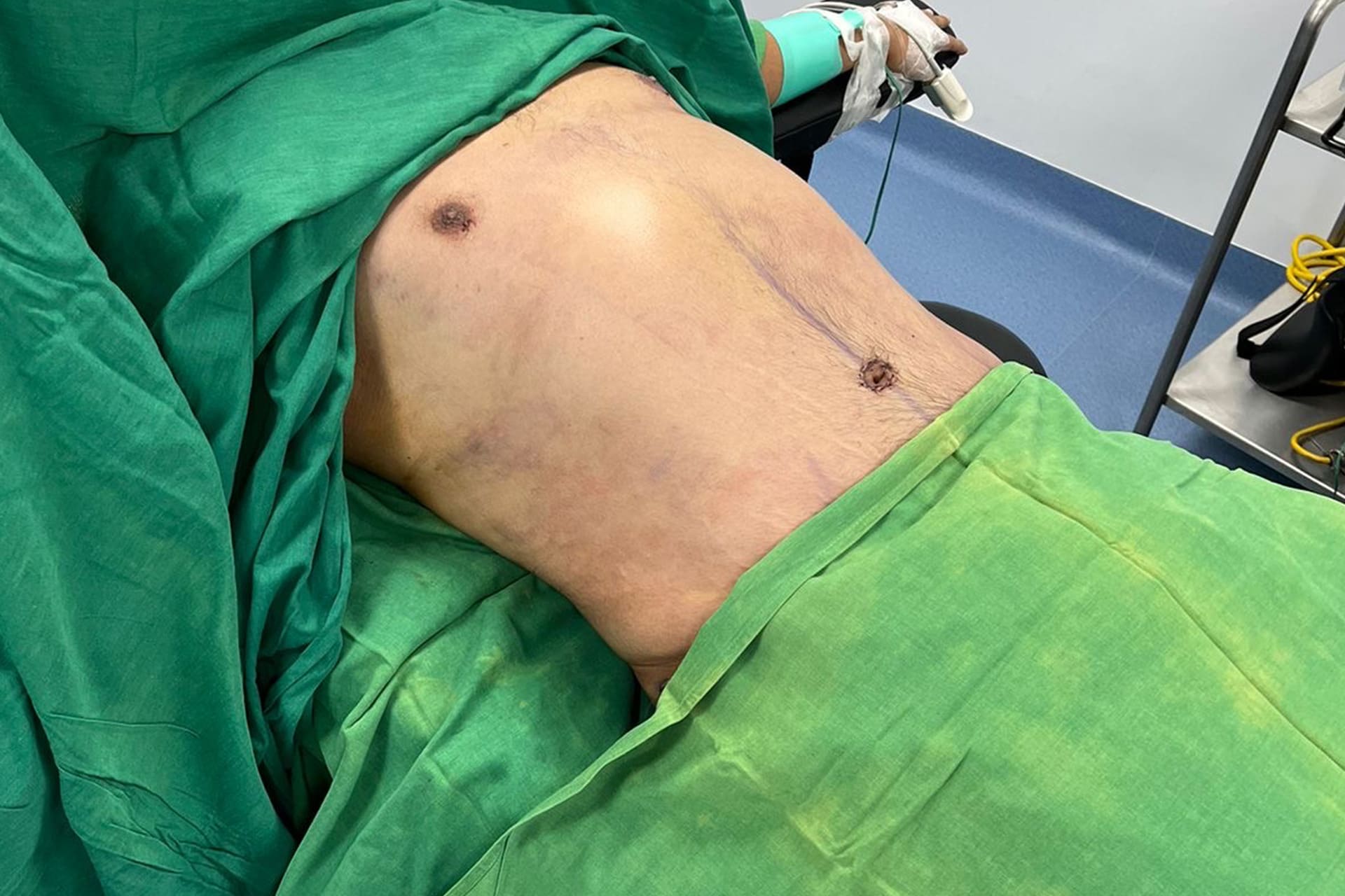 liposuccion