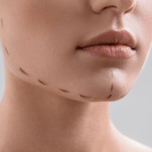 mentoplastia