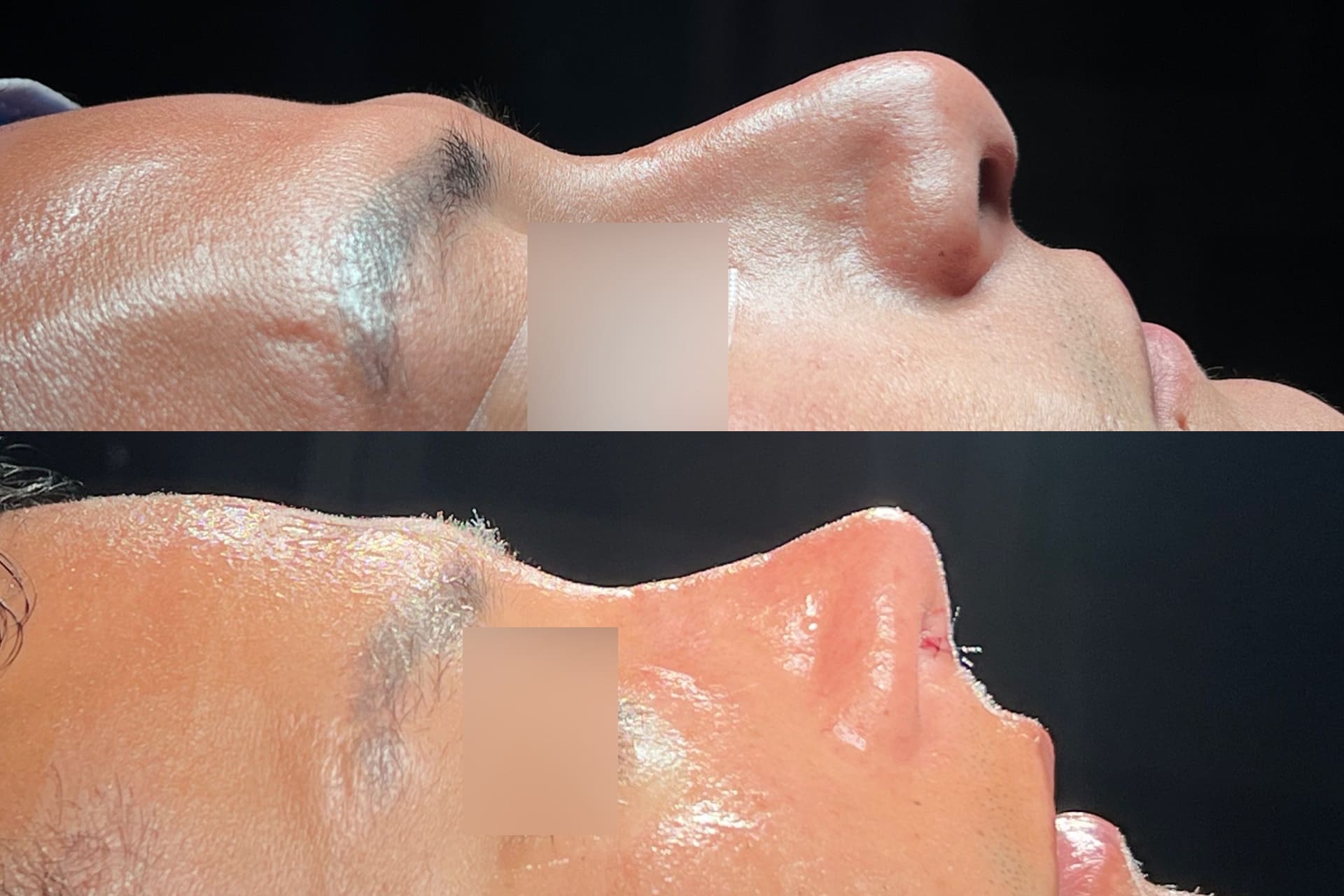 rinoplastia