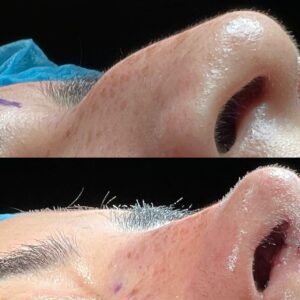 rinoplastia2