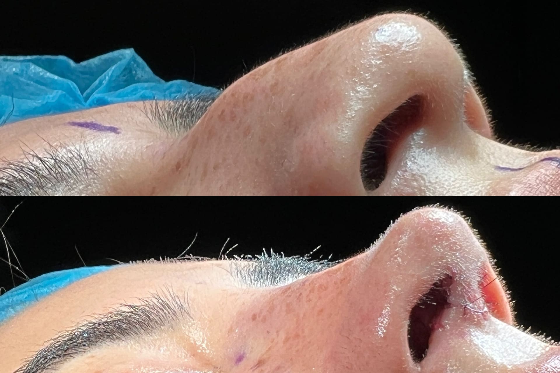 rinoplastia2