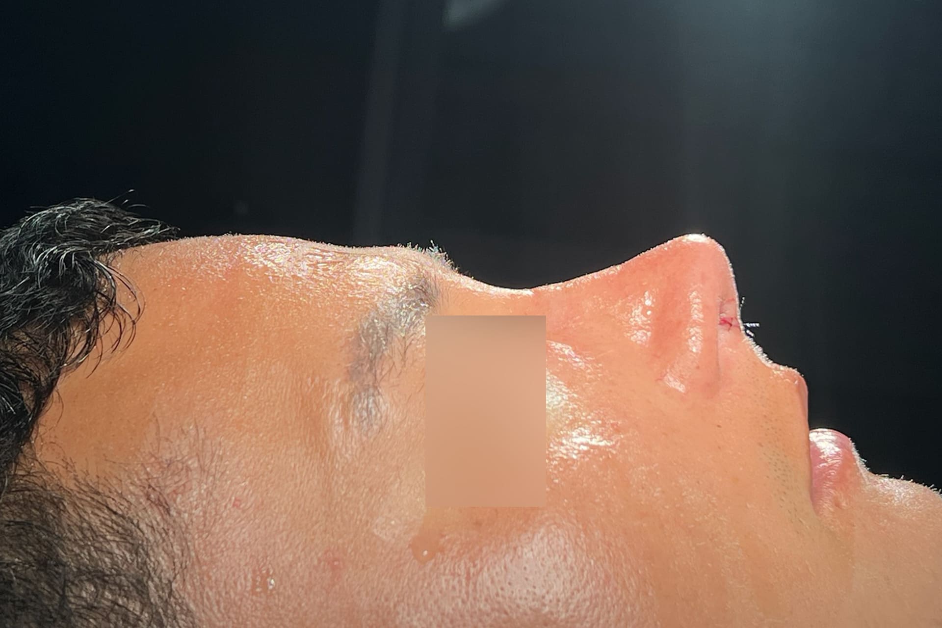rinoplastia3